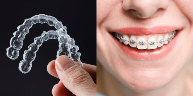 Invisalign vs braces