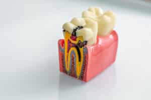 A 3D Dental Model of a tooth showcasing the different types of dental cavities